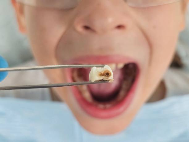 Best Emergency Dental Care for Broken or Chipped Teeth in Kenmar, PA